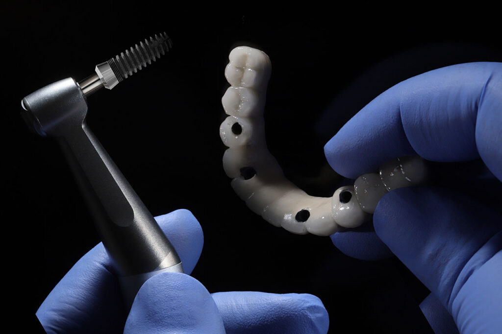 All-on-4 Full-Arch Dental Implants in Annapolis, How They Restore Function and Confidence