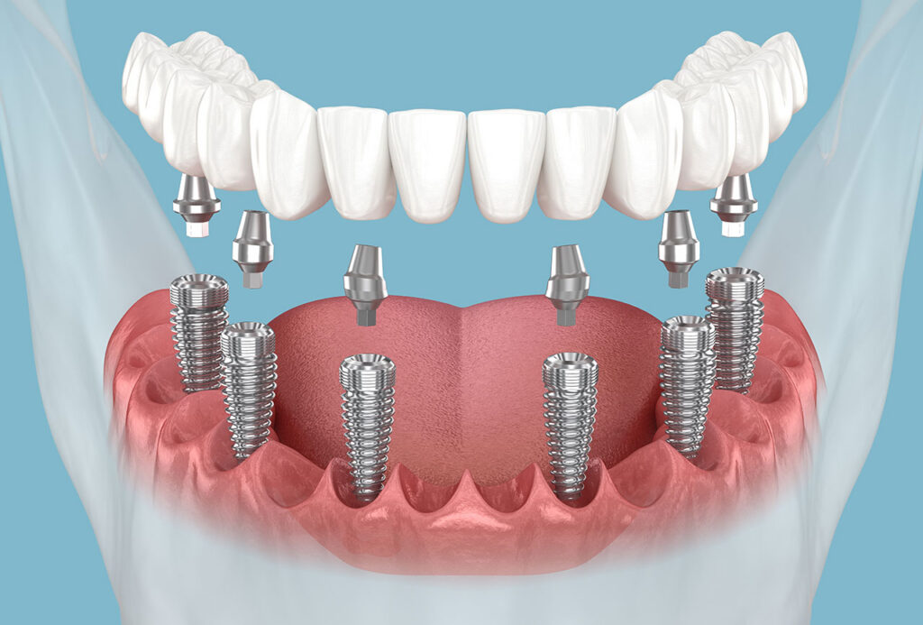 All-on-X Dental Implants in Annapolis, A Comprehensive Guide to Replacing Missing Teeth