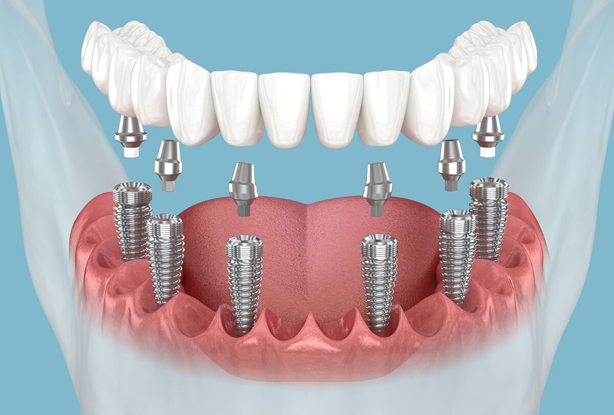 All-on-X Dental Implants in Annapolis, A Comprehensive Guide to Replacing Missing Teeth