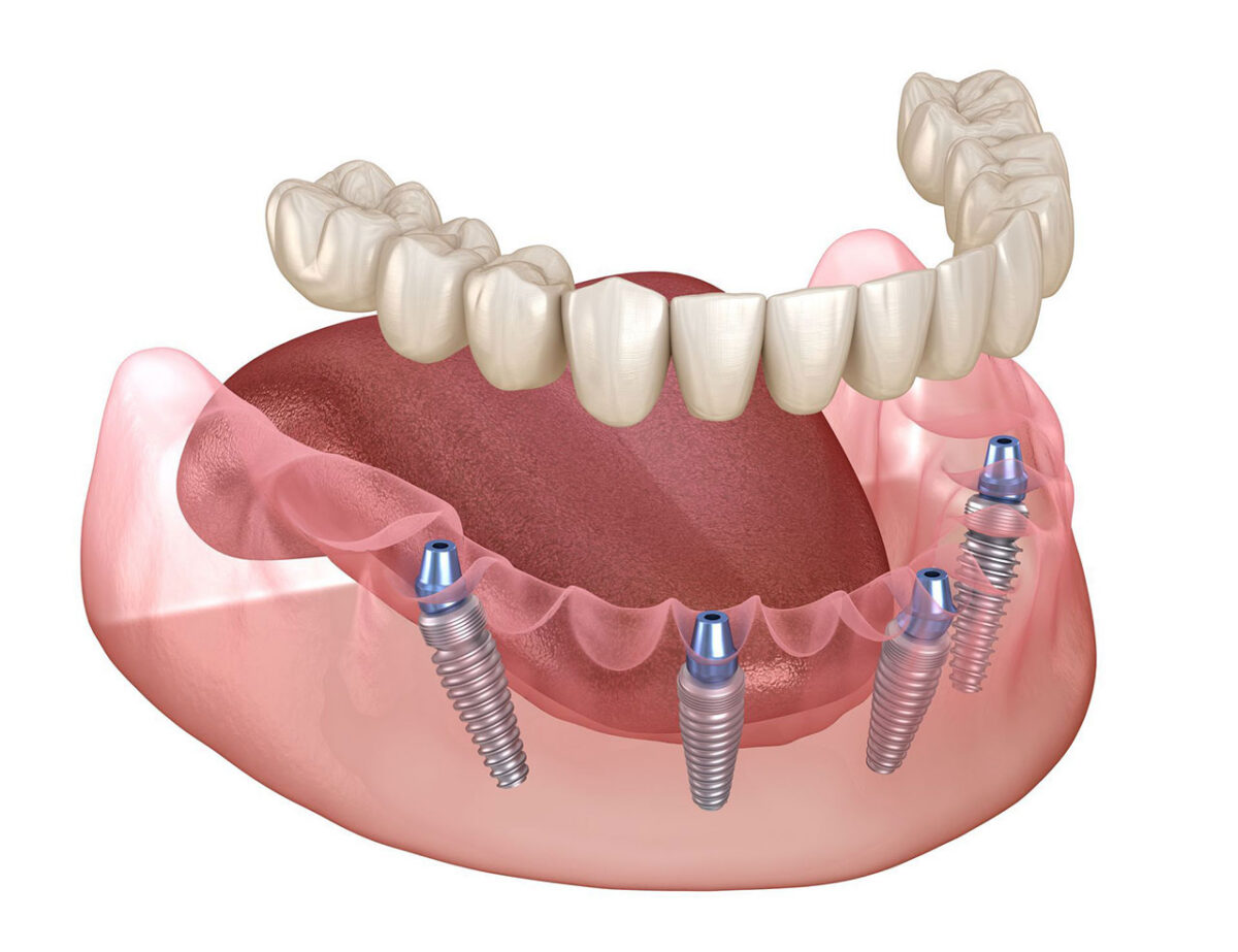 All-on-X vs All-on-4 Dental Implants in Annapolis, Understanding the Differences
