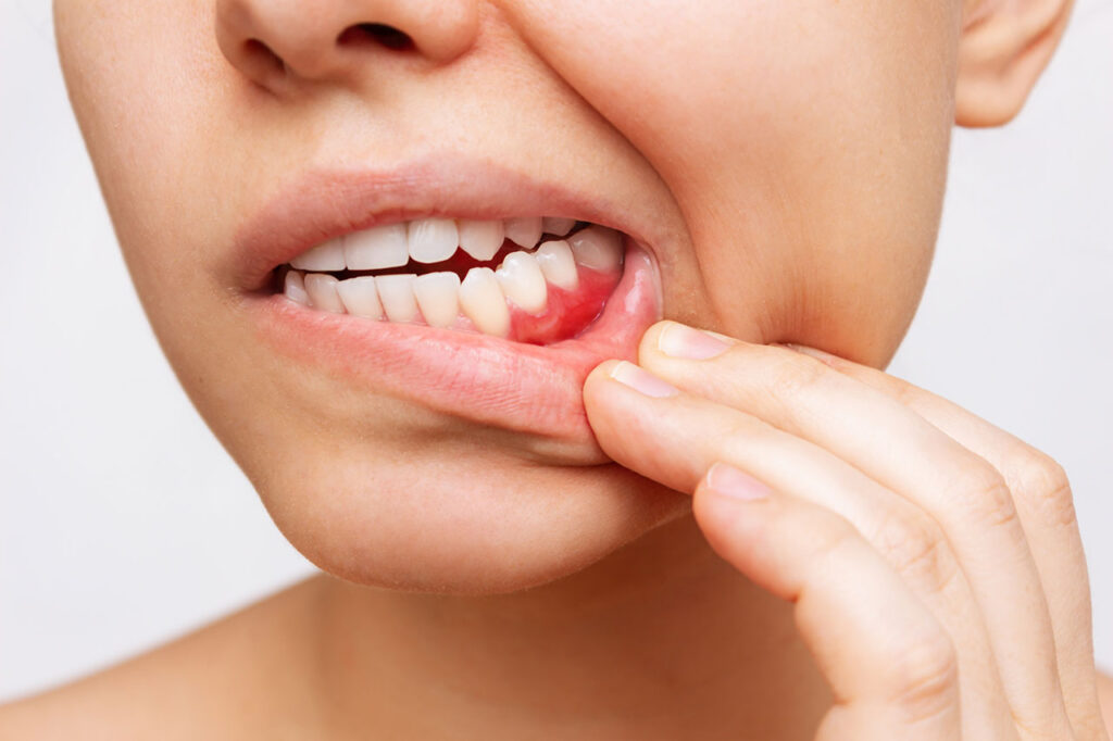 Gum Disease Therapy in Annapolis, Signs You Should Not Ignore and How Treatment Protects Your Smile
