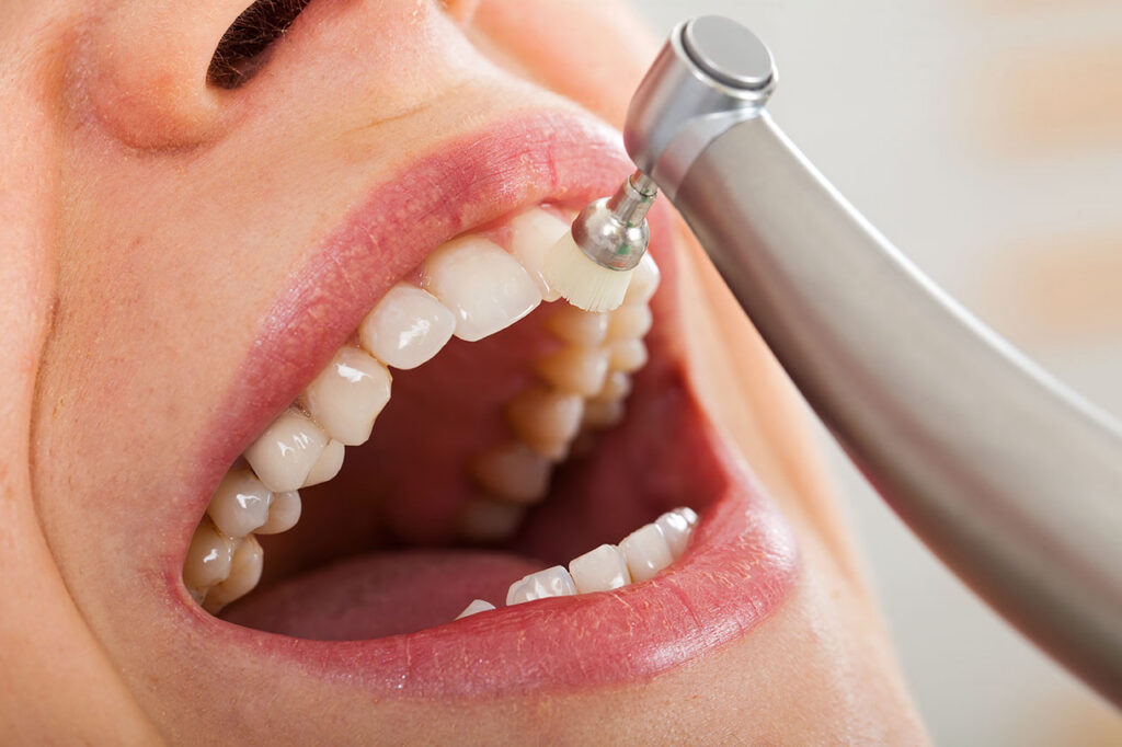 Professional Teeth Cleanings in Annapolis, What Happens During Your Appointment and Why They Matter